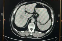 4 小时，出血仅 200 ml！