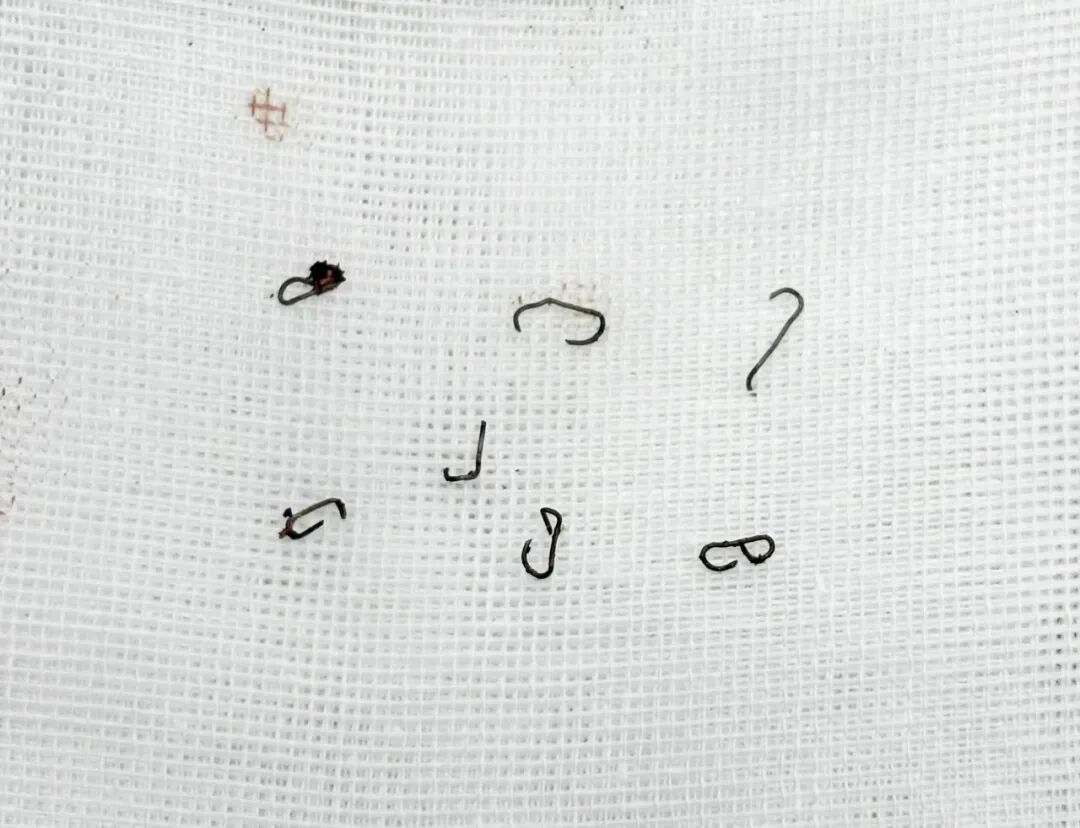 坐立难安半年，反复就医无果，医生一查：体内有 7 枚钉子