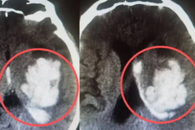 多科联动开绿灯！极速驰援，为危重脑出血患者抢回生机！