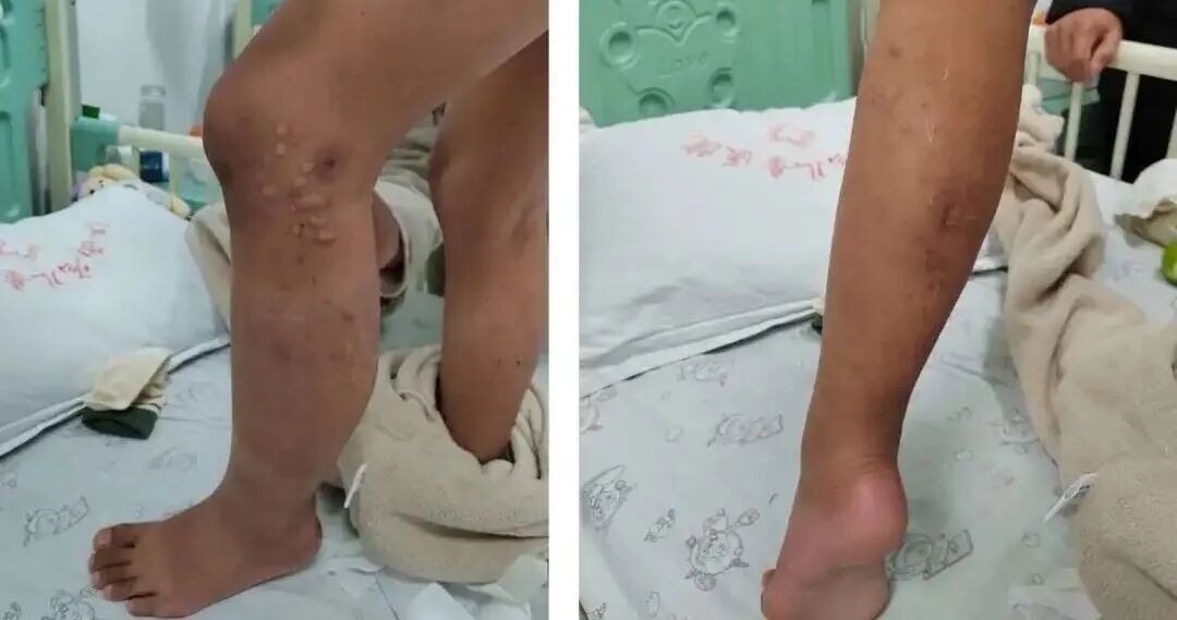 男孩腿肿 7 年,江西省儿童医院「介入」治疗助恢复