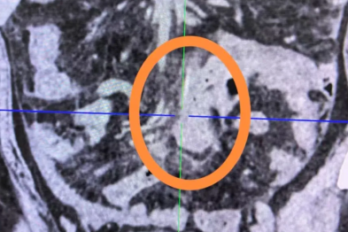 好端端的肠子竟然破了两个洞？追问：几天前剔牙打盹了！