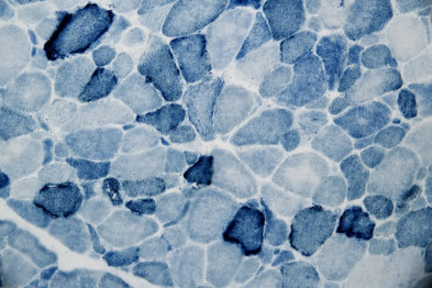 头晕腿软 20 年，大医院医生诊断「疲劳」！在这里确诊了罕见病