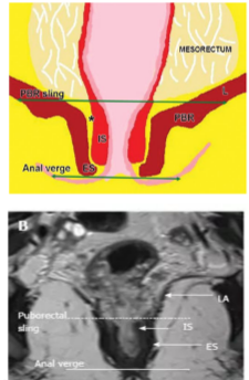 【高尚病例】直肠癌 MRI 评估与 TNM 分期