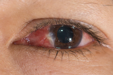 眼球上长出一层「肉」？这种常见眼病不容忽视