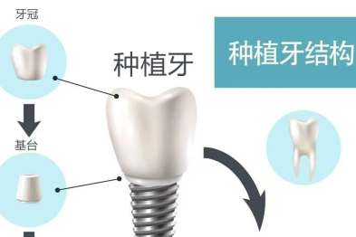 告别缺牙烦恼！种植牙让你享受美食自由