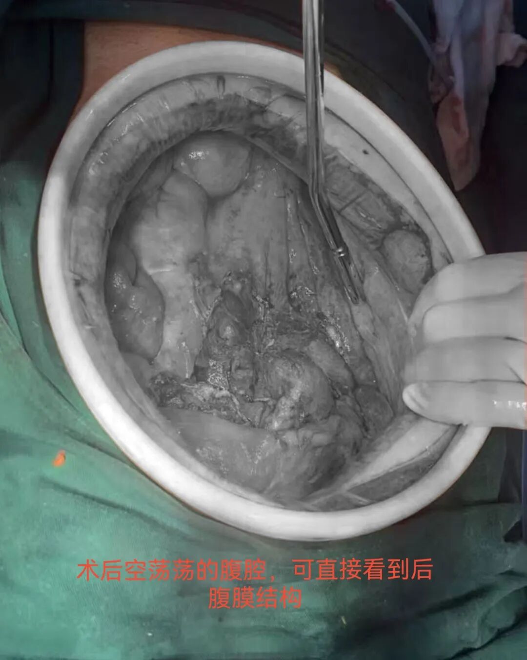 河北一洲肿瘤医院外科成功救治结肠癌复发合并完全性肠梗阻患者