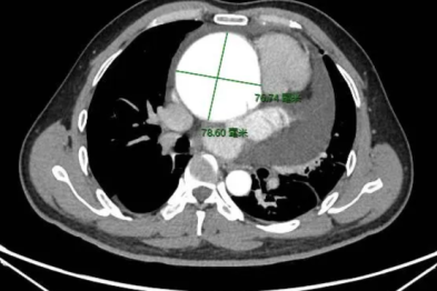 37 岁男子「身材修长」，心脏却是常人两倍大，元凶竟是这种罕见病