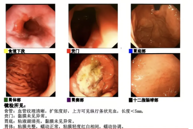 胃疼拖了一个月，做胃镜看到大溃疡，确诊胃癌！