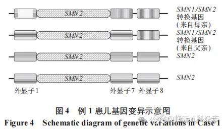 外显子 1 结构变异致脊髓性肌萎缩症 2 例临床分析并文献复习