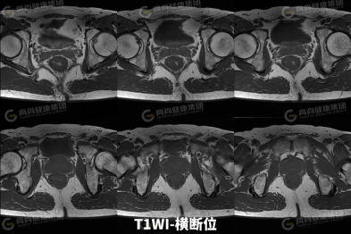 【高尚病例】直肠癌 MRI 评估与 TNM 分期