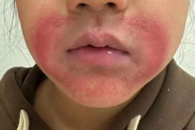 越干越舔，越舔越干！娃长了一圈「胡子」