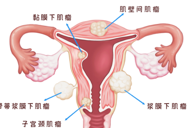 引起肌瘤复发的「元凶」，您了解吗？