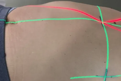 放疗必读 | 从衣服穿法到皮肤护理，这 8 条建议请收好