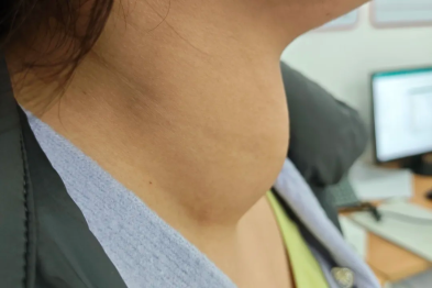 27 岁女子甲状腺长了拳头大的肿瘤，几乎堵住气管！