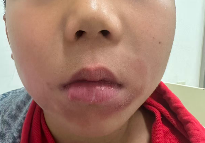 越干越舔，越舔越干！娃长了一圈「胡子」