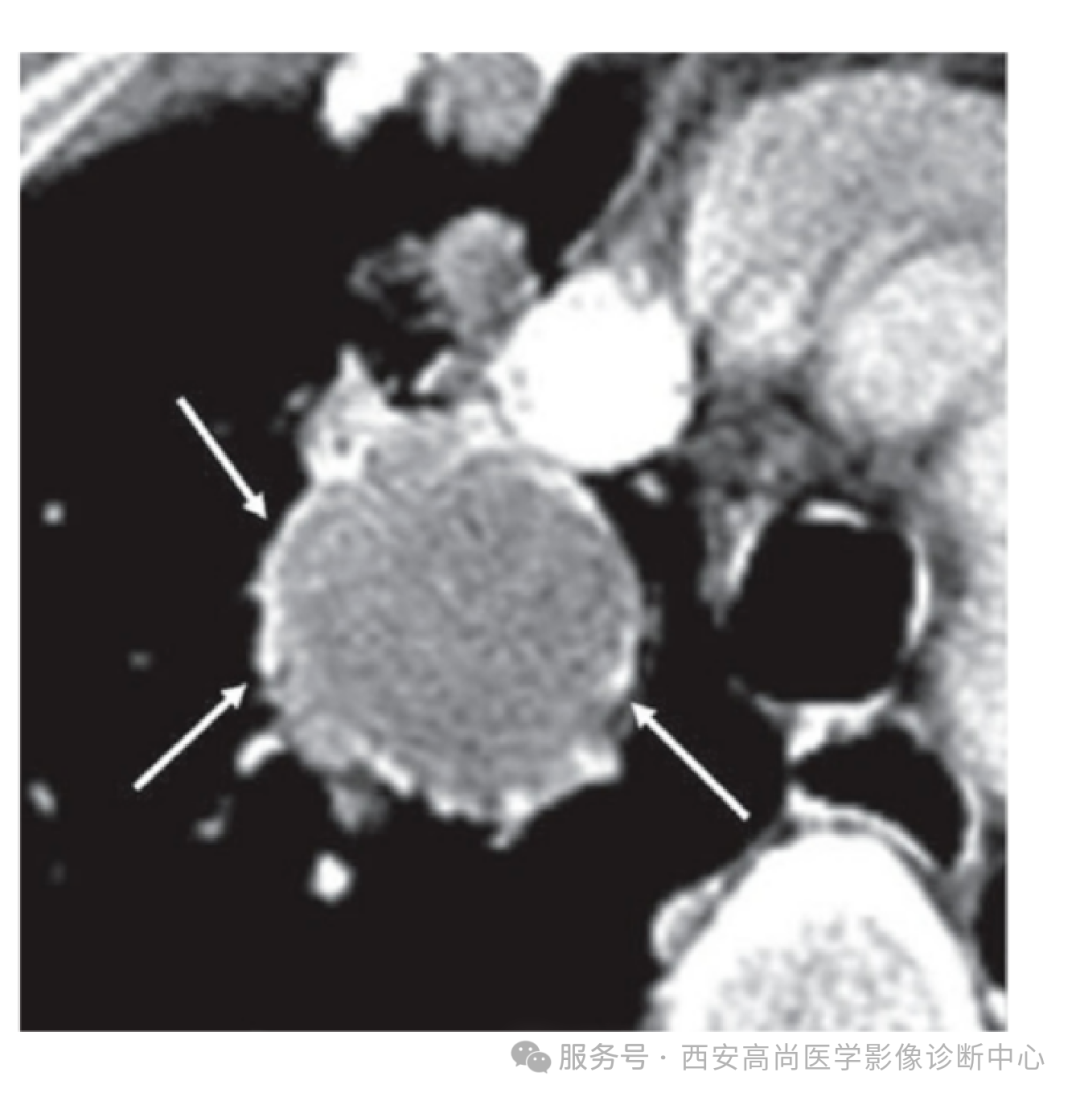 【高尚病例】巨大硬化性肺细胞瘤 1 例