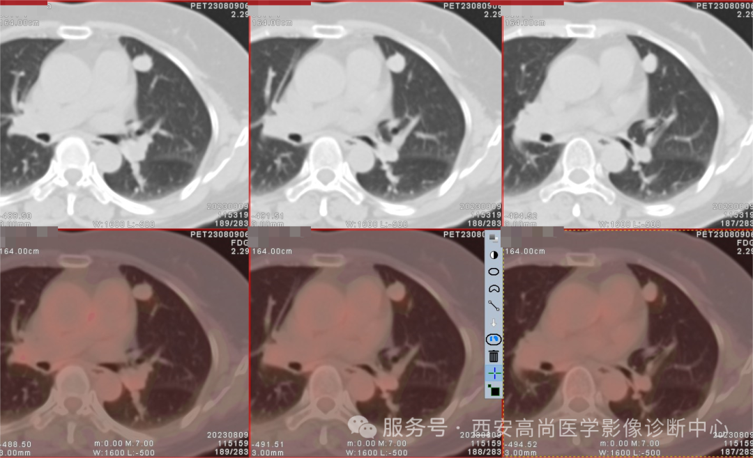【高尚病例】巨大硬化性肺细胞瘤 1 例