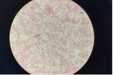 高热一周不退！常规药越吃越没用，医生一招揪出真凶