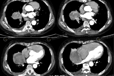 【高尚病例】巨大硬化性肺细胞瘤 1 例
