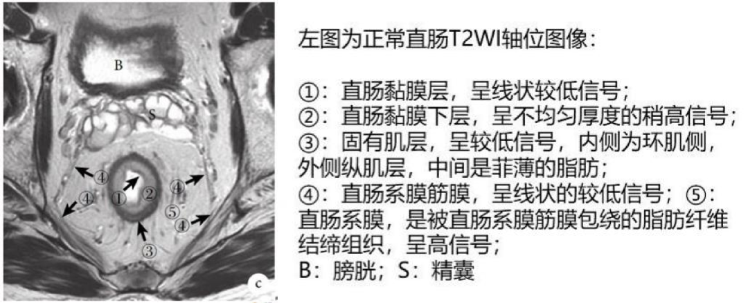 【高尚病例】直肠癌 MRI 评估与 TNM 分期