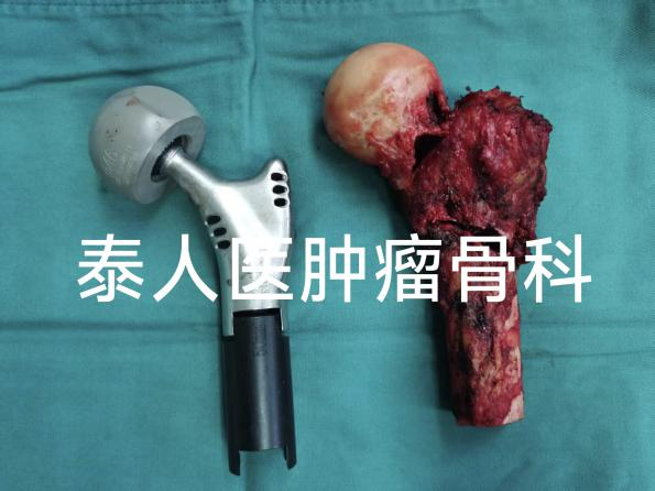 泰州市人民医院骨科团队成功实施首例近端骨肿瘤根治术