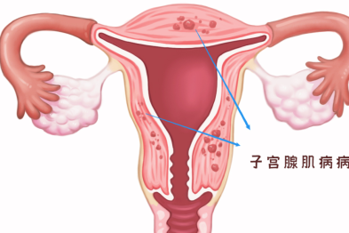 关于子宫腺肌病，你需要了解这些！