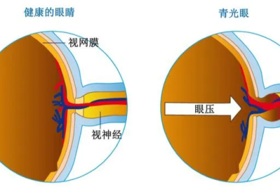 凝聚各界力量，共防青光眼盲 | 第 19 个世界青光眼周，爱尔眼科邀你防「青」