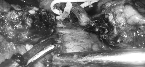 精准攻坚胆道梗阻，郑大五附院肝胆胰腺外科成功实施 LPD 手术