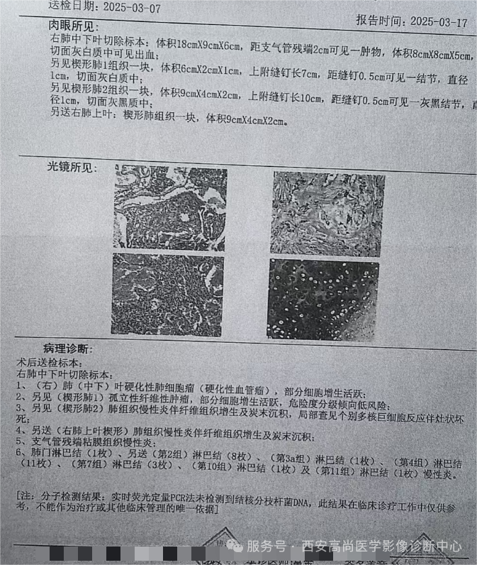 【高尚病例】巨大硬化性肺细胞瘤 1 例