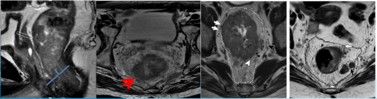 【高尚病例】直肠癌 MRI 评估与 TNM 分期