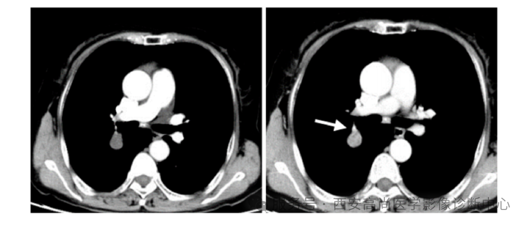 【高尚病例】巨大硬化性肺细胞瘤 1 例