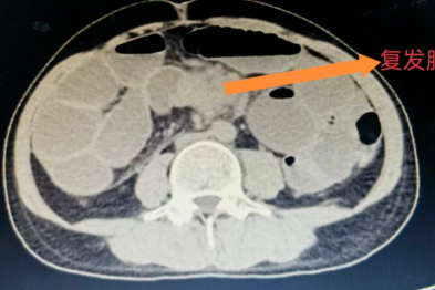 河北一洲肿瘤医院外科成功救治结肠癌复发合并完全性肠梗阻患者