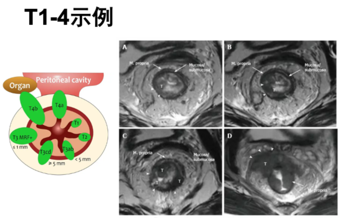 【高尚病例】直肠癌 MRI 评估与 TNM 分期