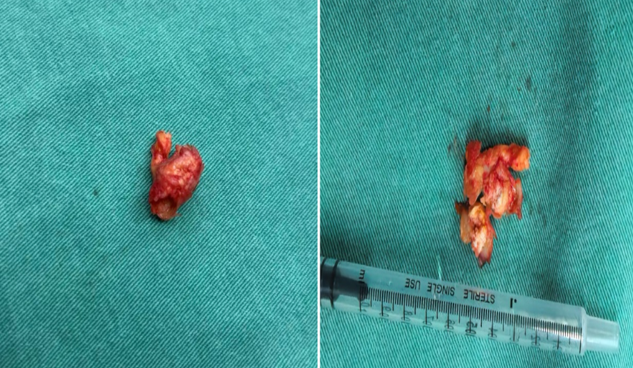 精准「拆弹」！重庆松山医院首例颈动脉内膜剥脱术，为八旬老人清淤救命