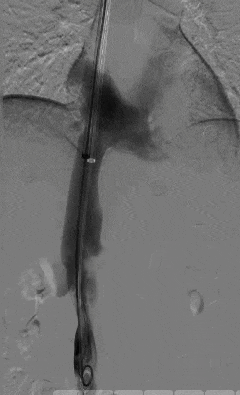 滤器 3 月卡壳体内,医生:这东西一定记得按时从体内取出