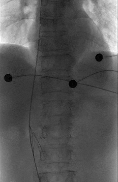 滤器 3 月卡壳体内,医生:这东西一定记得按时从体内取出