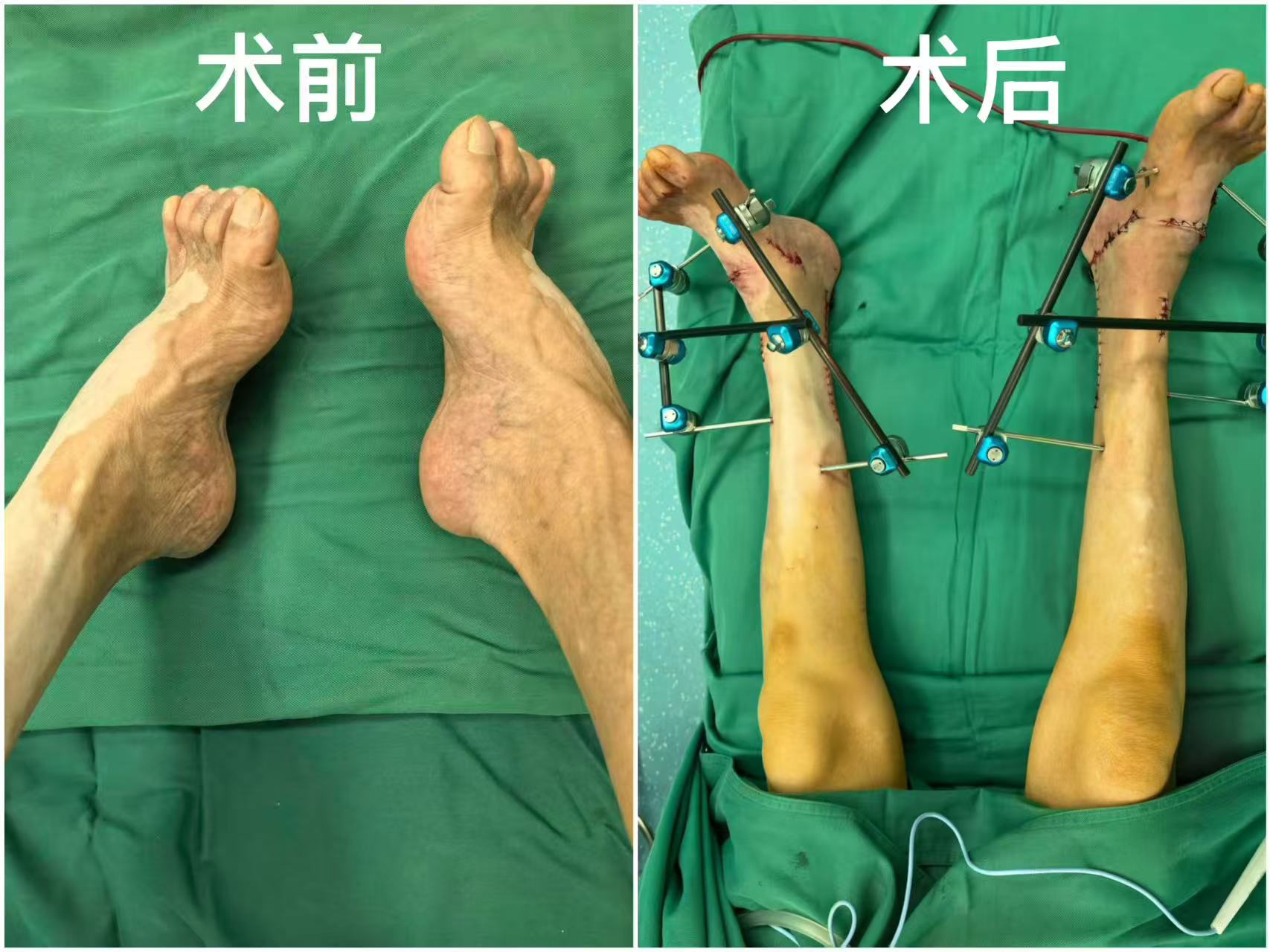 跛行 62 载终圆正常行走梦 武汉大学人民医院骨科专家精准矫治足踝重度畸形