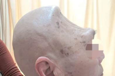 1/4 颅骨被切，头皮不足 1/3 厚！76 岁老人重塑「天灵盖」…