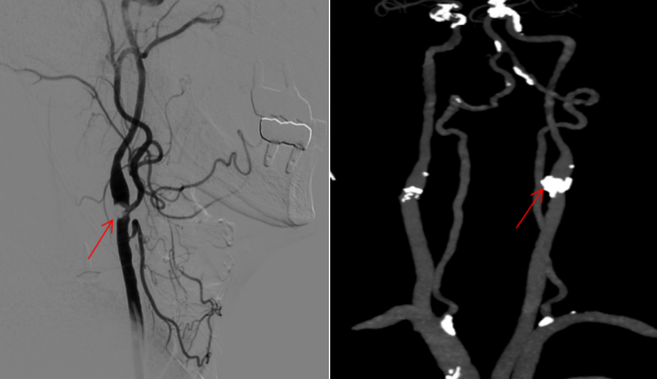 精准「拆弹」！重庆松山医院首例颈动脉内膜剥脱术，为八旬老人清淤救命