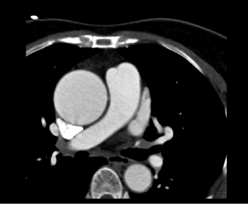 53 岁患者遇心脏复杂难题，南医大三附院成功为其实施主动脉瓣成形联合升主动脉置换术