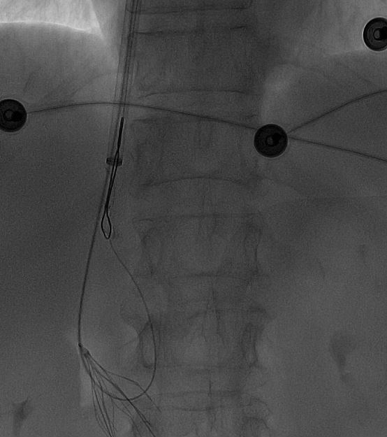 滤器 3 月卡壳体内,医生:这东西一定记得按时从体内取出