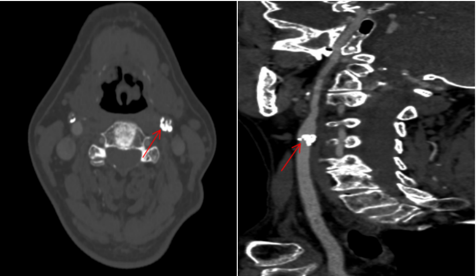 精准「拆弹」！重庆松山医院首例颈动脉内膜剥脱术，为八旬老人清淤救命