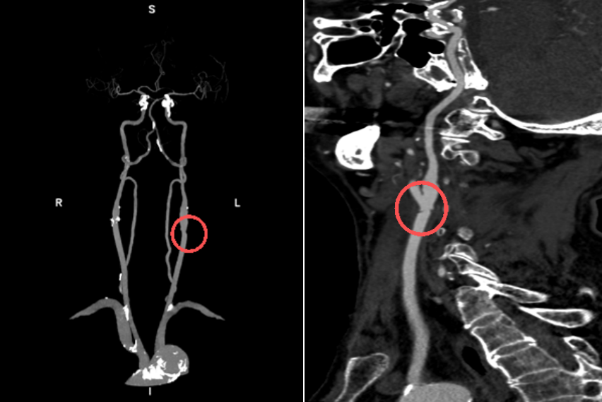精准「拆弹」！重庆松山医院首例颈动脉内膜剥脱术，为八旬老人清淤救命