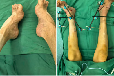 跛行 62 载终圆正常行走梦  武汉大学人民医院骨科专家精准矫治足踝重度畸形