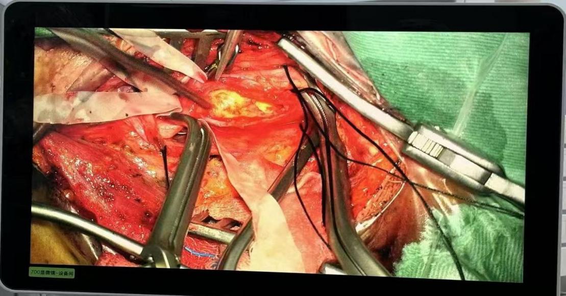 精准「拆弹」！重庆松山医院首例颈动脉内膜剥脱术，为八旬老人清淤救命