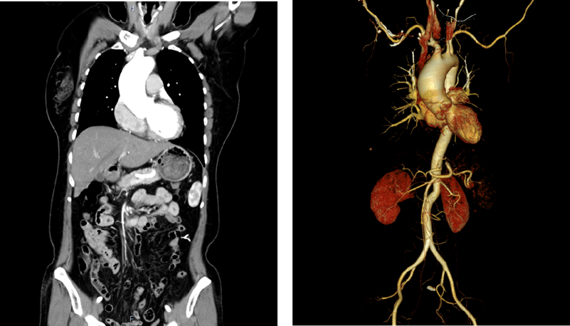 53 岁患者遇心脏复杂难题，南医大三附院成功为其实施主动脉瓣成形联合升主动脉置换术