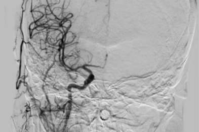 心脏「泵血」仅 20%！七旬老人突发脑栓塞，多学科联手闯过生死关