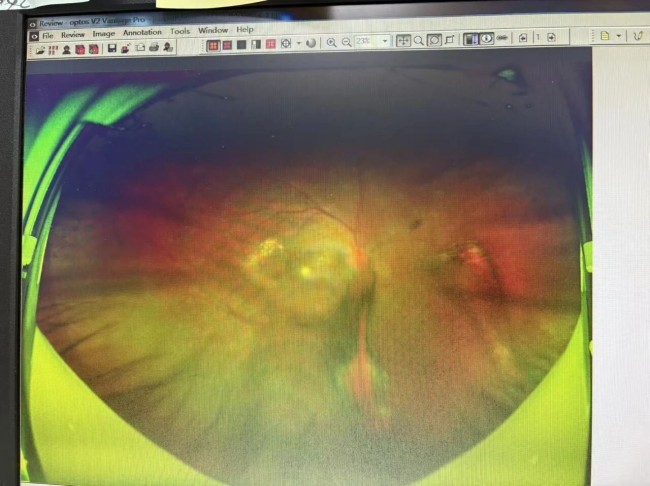 5 年糖尿病视力仅 0.15，厦门眼科中心漳州眼科医院紧急提醒：定期查眼底刻不容缓