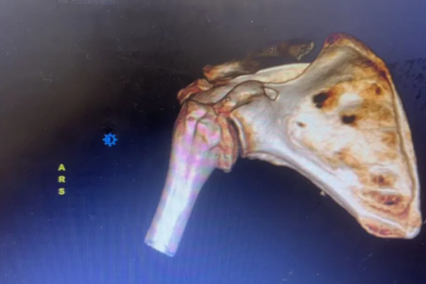 走路摔断肩膀，南医大三附院（常州二院）反肩置换术为患者 「肩」 赋新生