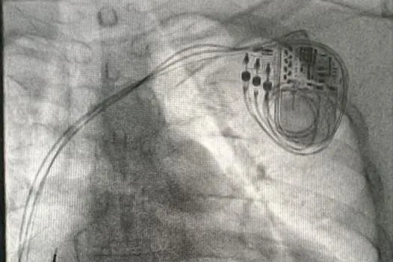 42 岁男子重度心衰，桂医大一附院 CRT 助力重获「心」生